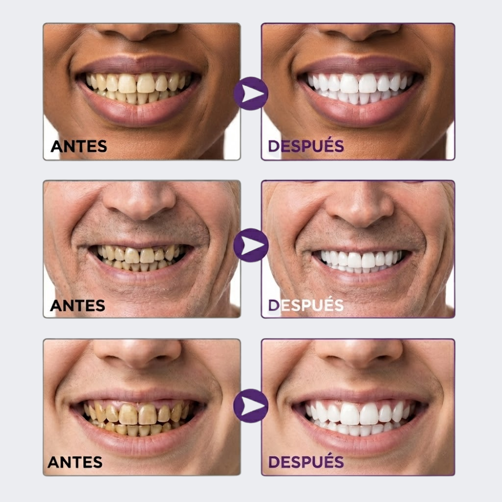 WHITEPRO™ | Sonrisa más blanca al instante desde la primera aplicación