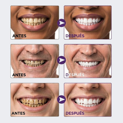 WHITEPRO™ | Sonrisa más blanca al instante desde la primera aplicación